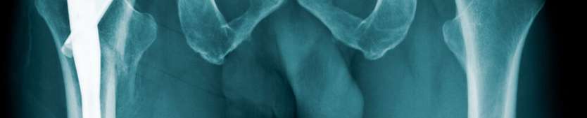 Hip X-Ray