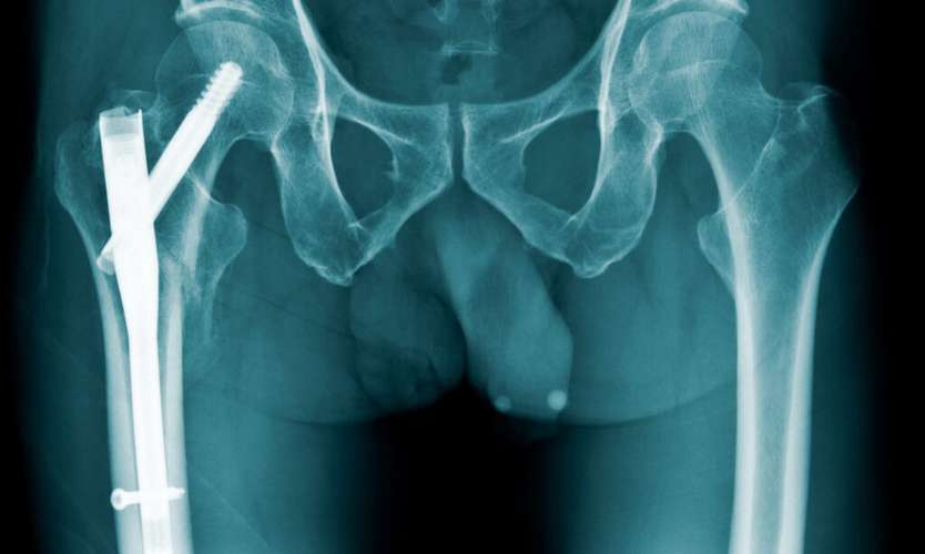 Hip X-Ray