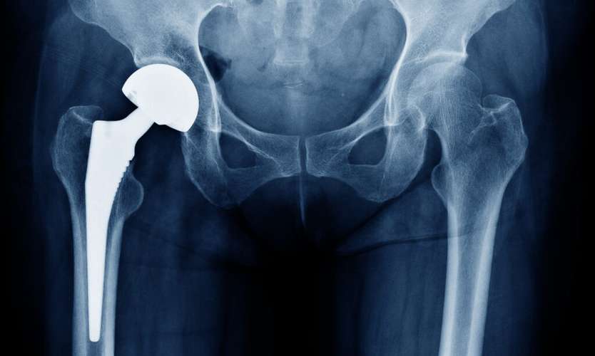 Hip X-Ray