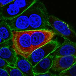 Colon cancer cells infected with E. coli