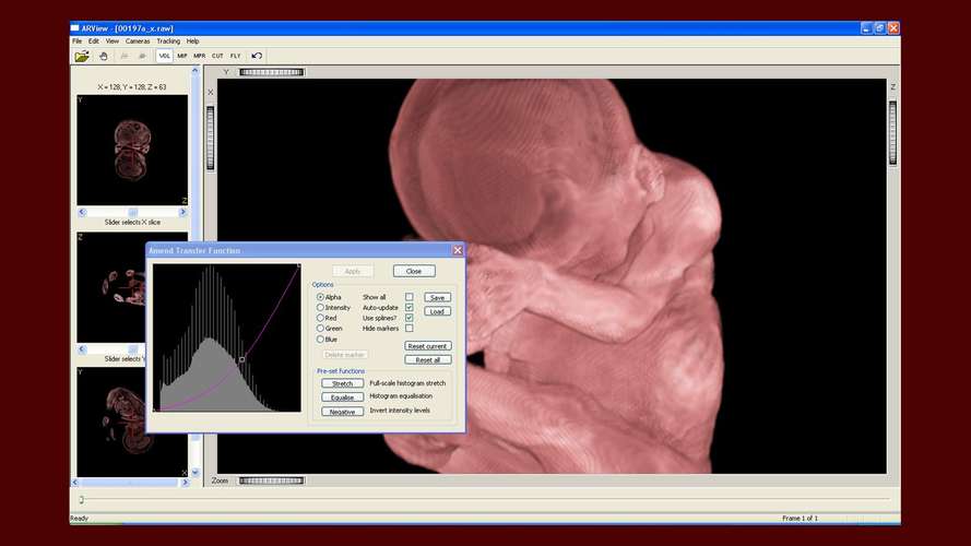fetal head moulding image