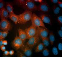 Osteosarcoma cells seen under a microscope