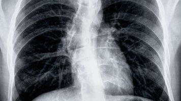 Xray of chest