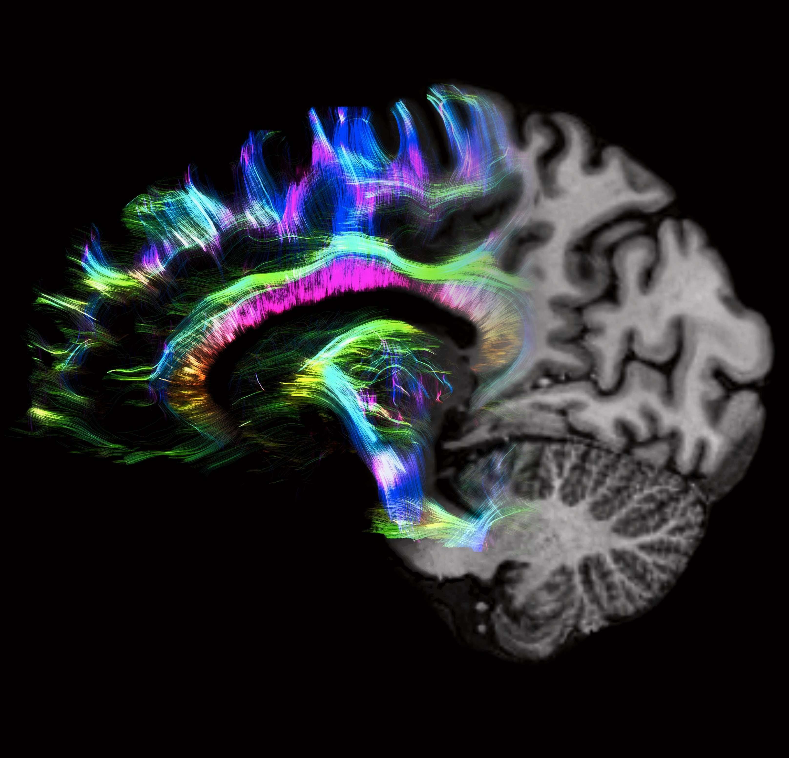 A colourful visualisation of the brain's white matter tracts from a DTI scan, showcasing neuroscience and medical imaging research in Norwich.