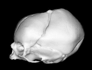 4 Lateral view of deformed fetal skull.jpg