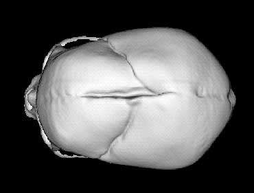 6 Top view of deformed fetal skull.jpg