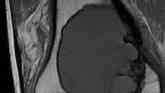 Bone tumour in the distal femur
