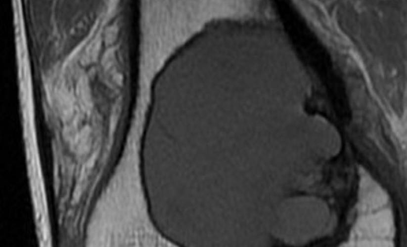 Bone tumour in the distal femur