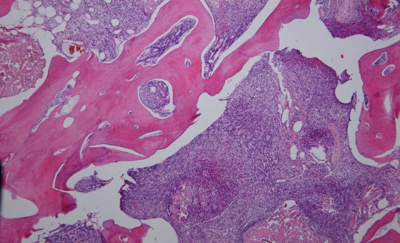 Phosphaturic mesenchymal tumour h+e stain