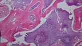 Phosphaturic mesenchymal tumour h+e stain
