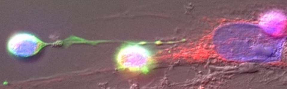 Microscopic image of the myeloma microenvironment