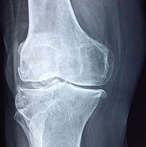 Xray image of a knee joint